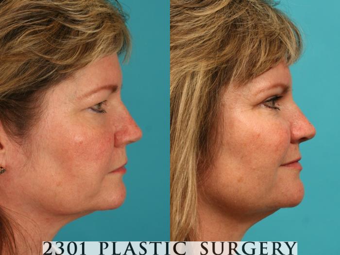 Before & After Blepharoplasty Case 55 View #2 View in Fort Worth, Plano, & Frisco, Texas