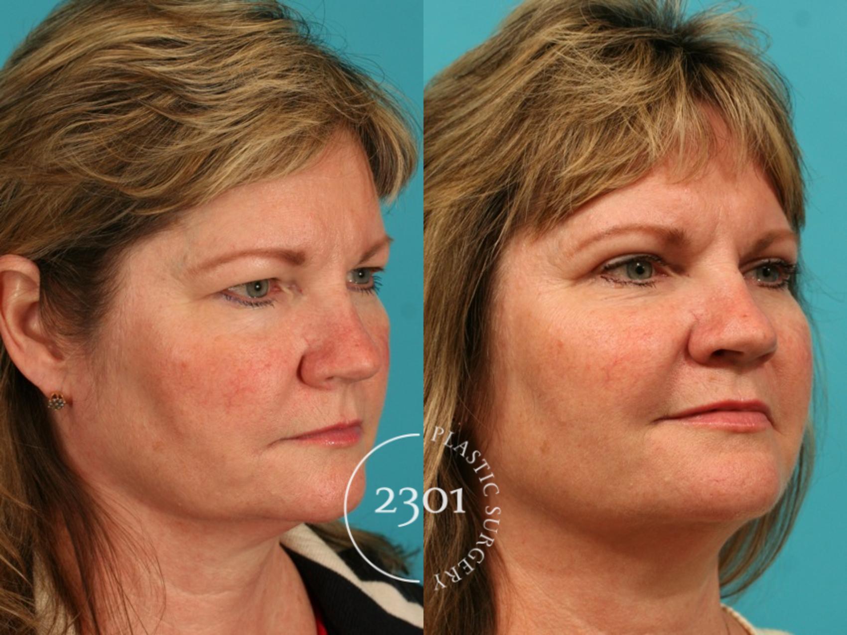 Before & After Blepharoplasty Case 55 View #3 View in Fort Worth, Plano, & Frisco, Texas