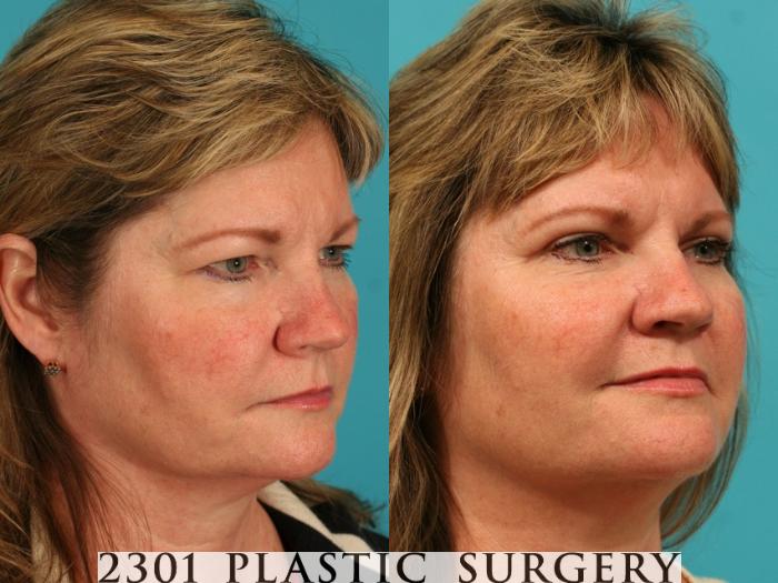 Before & After Blepharoplasty Case 55 View #3 View in Fort Worth, Plano, & Frisco, Texas