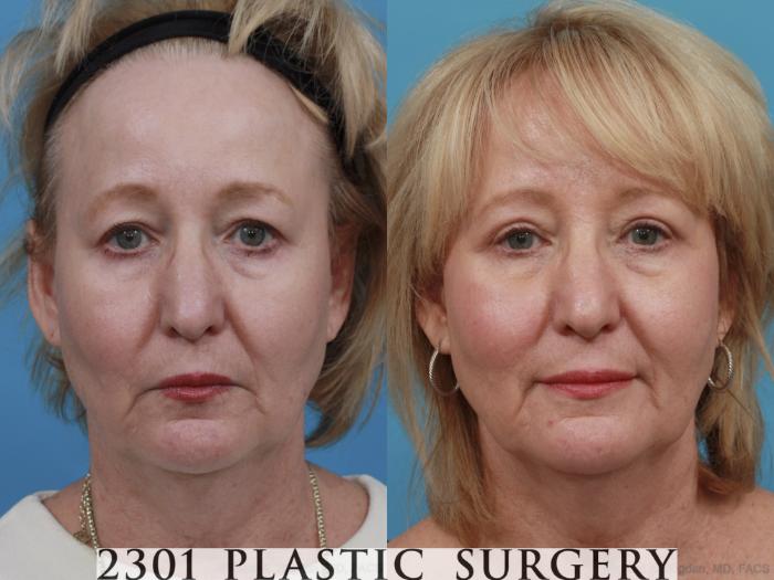 Before & After Blepharoplasty Case 551 View #1 View in Fort Worth, Plano, & Frisco, Texas