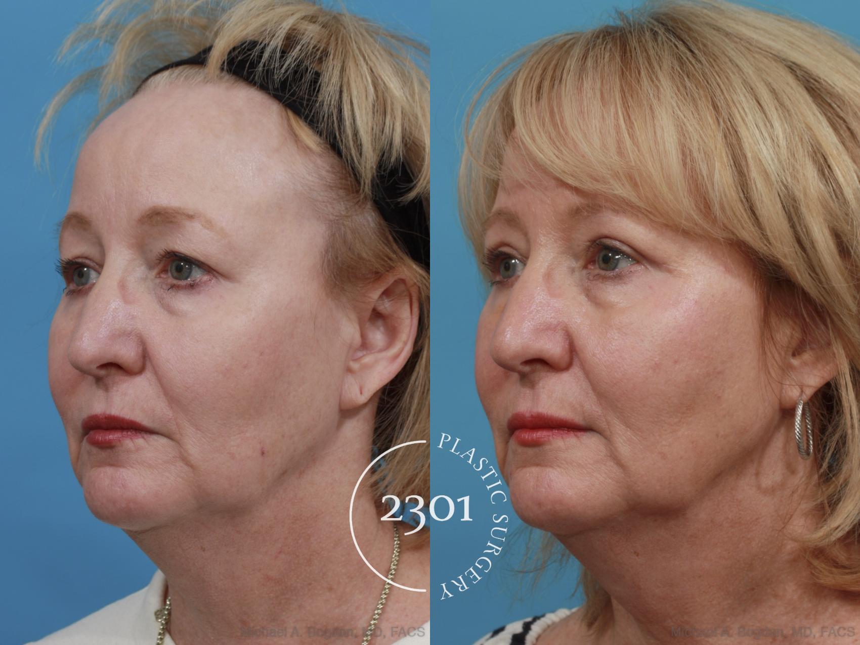 Before & After Blepharoplasty Case 551 View #2 View in Fort Worth, Plano, & Frisco, Texas