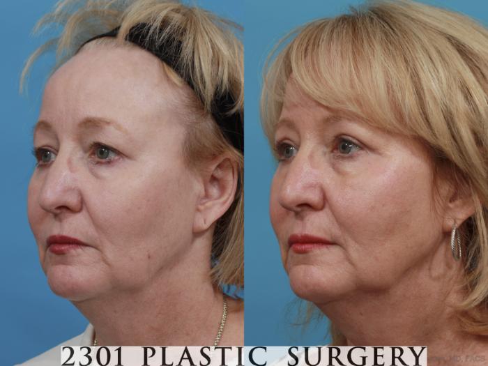 Before & After Blepharoplasty Case 551 View #2 View in Fort Worth, Plano, & Frisco, Texas