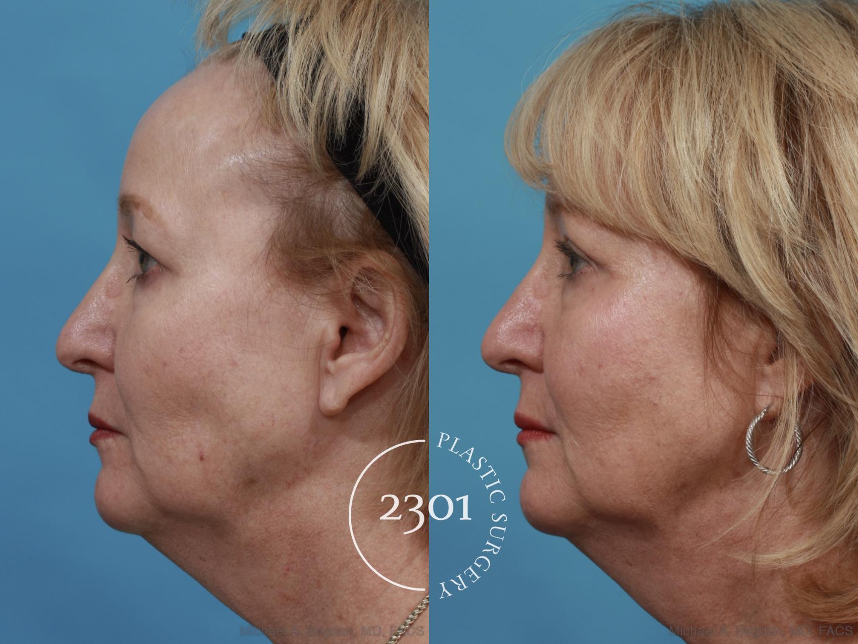 Before & After Blepharoplasty Case 551 View #3 View in Fort Worth, Plano, & Frisco, Texas