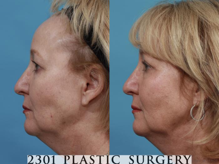 Before & After Blepharoplasty Case 551 View #3 View in Fort Worth, Plano, & Frisco, Texas