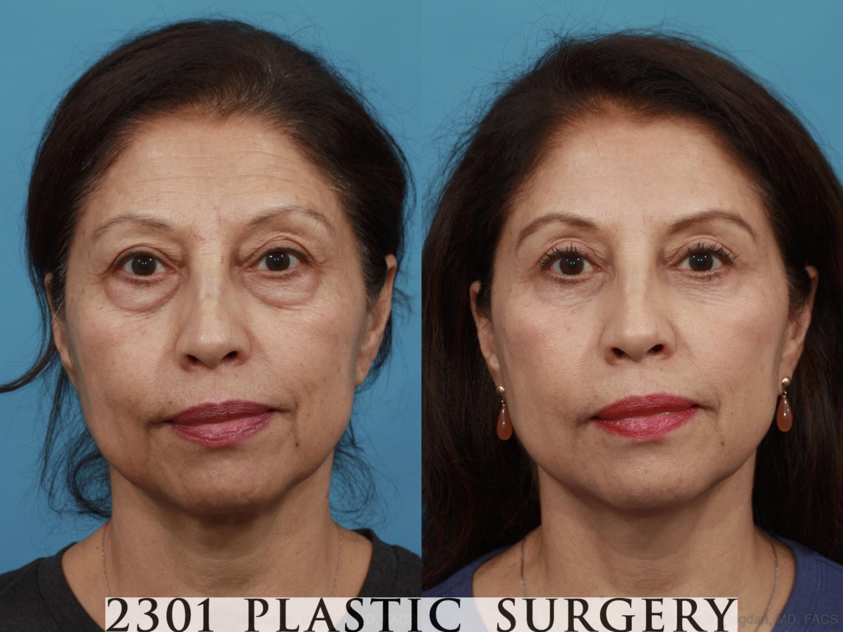 Before & After Blepharoplasty Case 555 View #1 View in Fort Worth, Plano, & Frisco, Texas