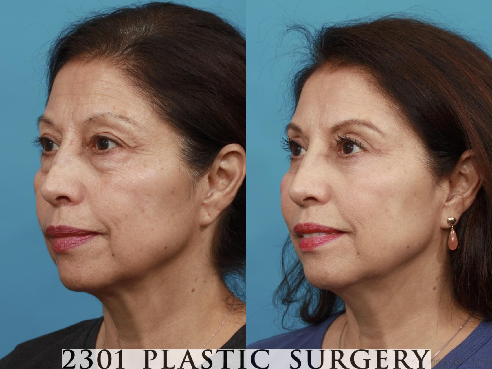 Before & After Blepharoplasty Case 555 View #2 View in Fort Worth & Frisco, Texas