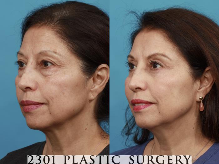 Before & After Blepharoplasty Case 555 View #2 View in Fort Worth, Plano, & Frisco, Texas
