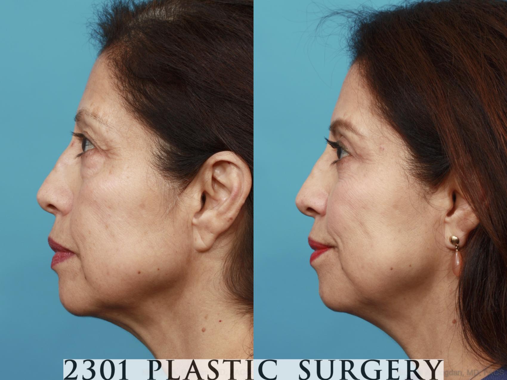 Before & After Blepharoplasty Case 555 View #3 View in Fort Worth & Frisco, Texas