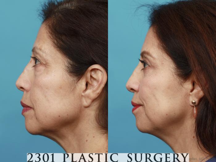 Before & After Blepharoplasty Case 555 View #3 View in Fort Worth, Plano, & Frisco, Texas