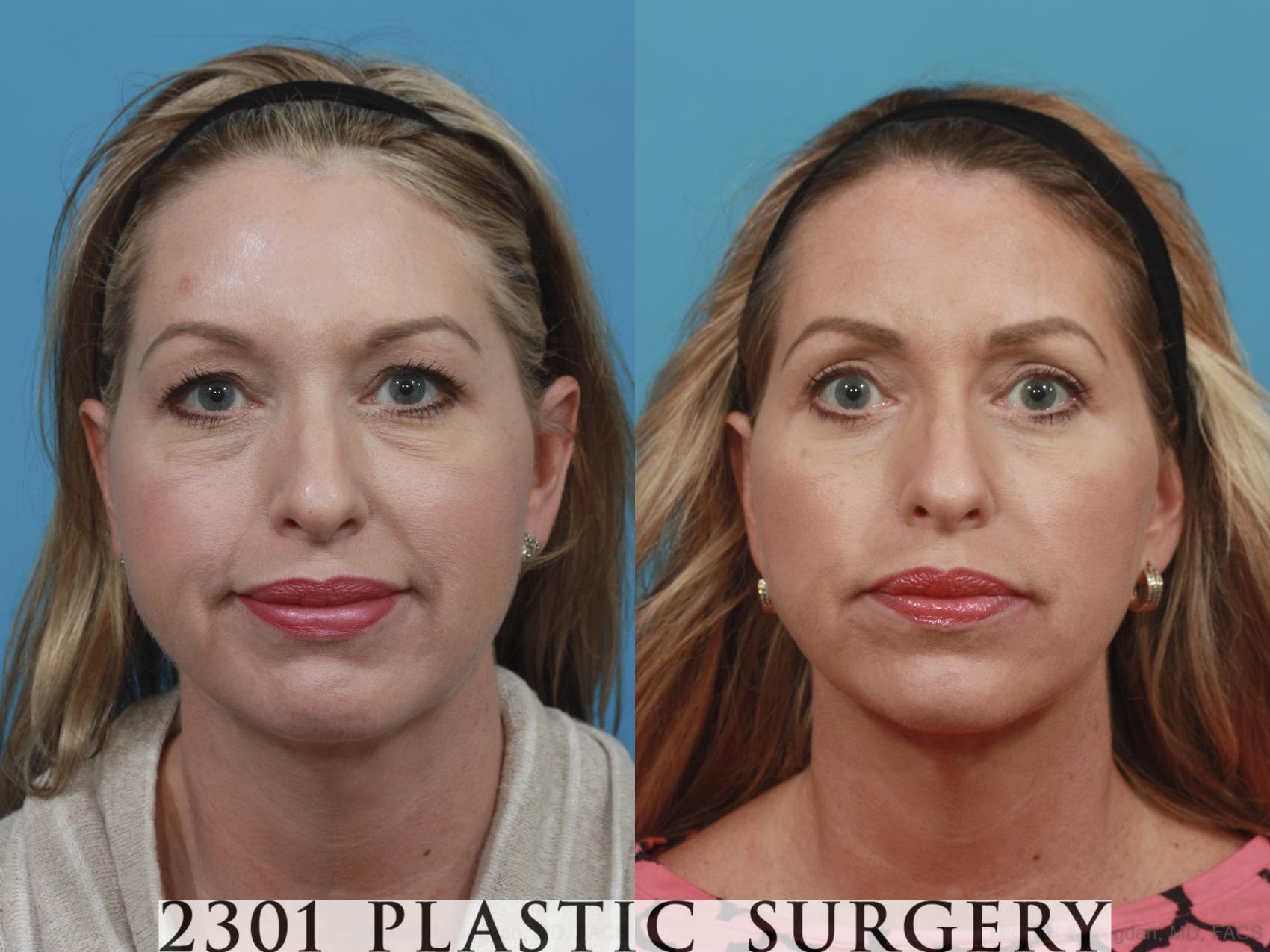 Before & After Blepharoplasty Case 582 View #1 View in Fort Worth & Frisco, Texas