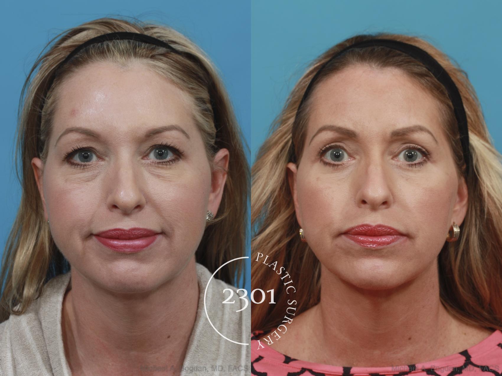 Before & After Blepharoplasty Case 582 View #1 View in Fort Worth, Plano, & Frisco, Texas