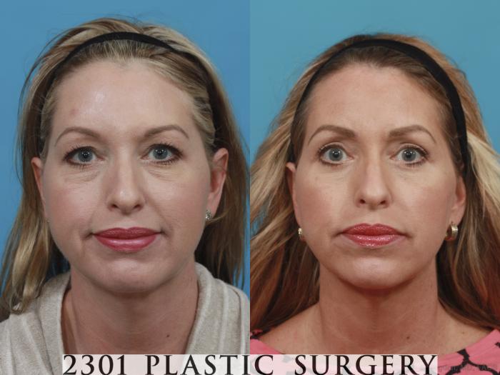 Before & After Blepharoplasty Case 582 View #1 View in Fort Worth, Plano, & Frisco, Texas