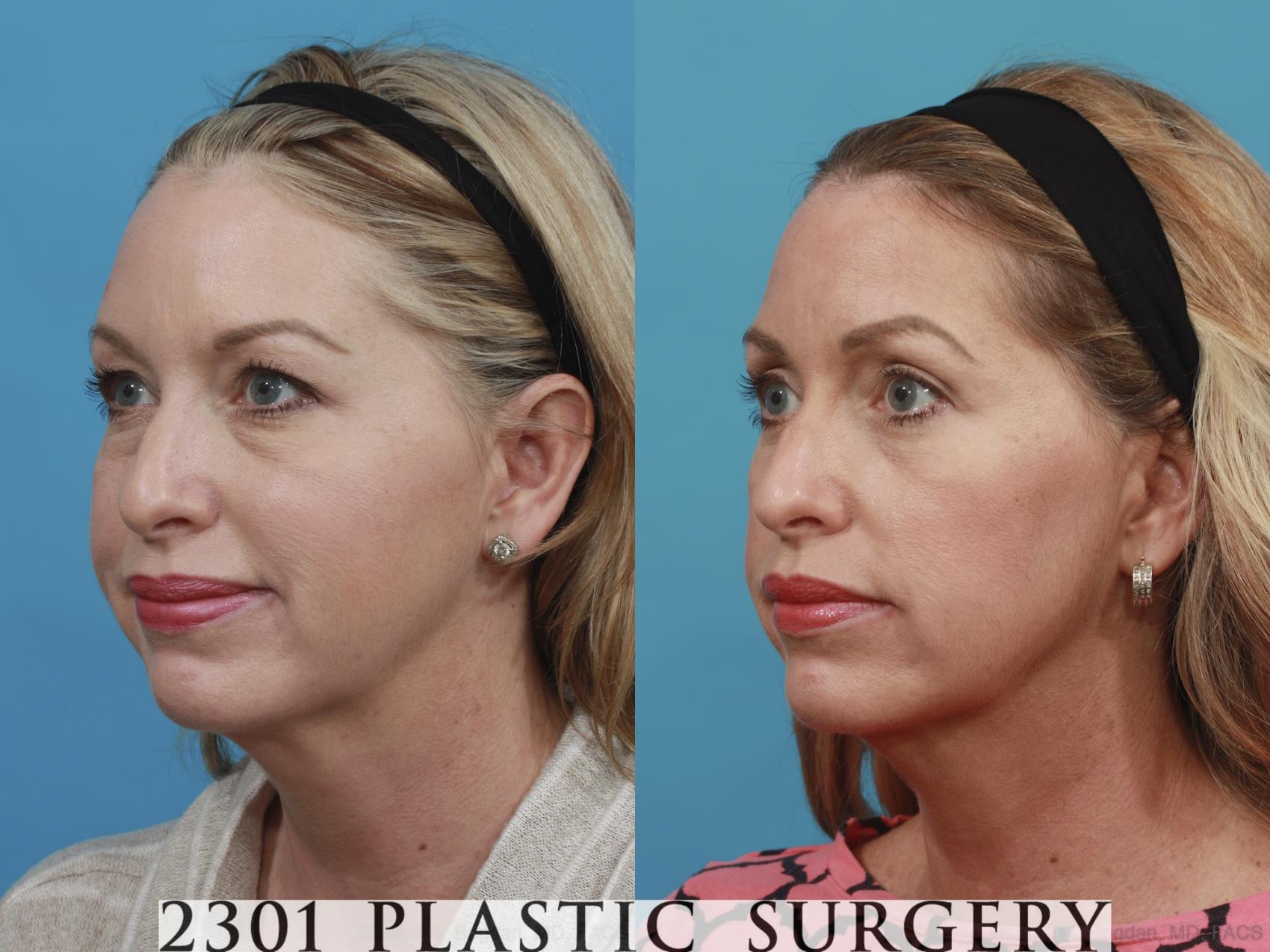 Before & After Blepharoplasty Case 582 View #2 View in Fort Worth & Frisco, Texas