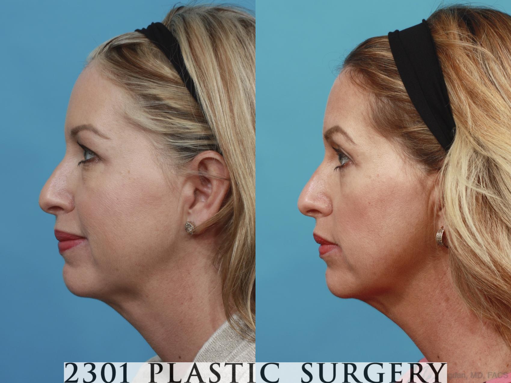 Before & After Blepharoplasty Case 582 View #3 View in Fort Worth & Frisco, Texas