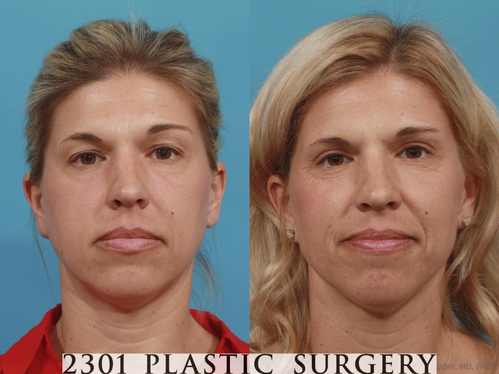 Before & After Blepharoplasty Case 589 View #1 View in Fort Worth, Plano, & Frisco, Texas