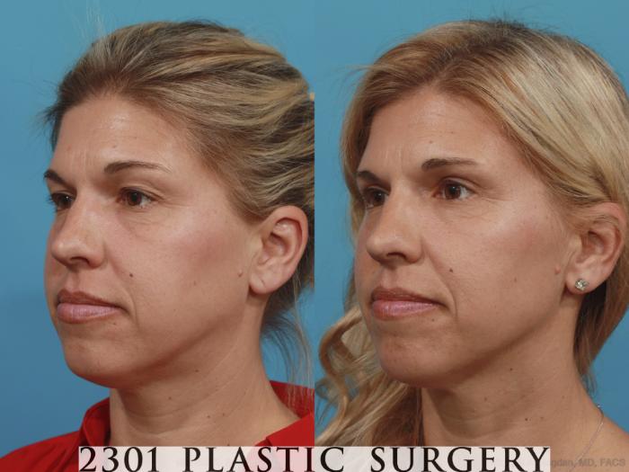 Before & After Blepharoplasty Case 589 View #2 View in Fort Worth, Plano, & Frisco, Texas