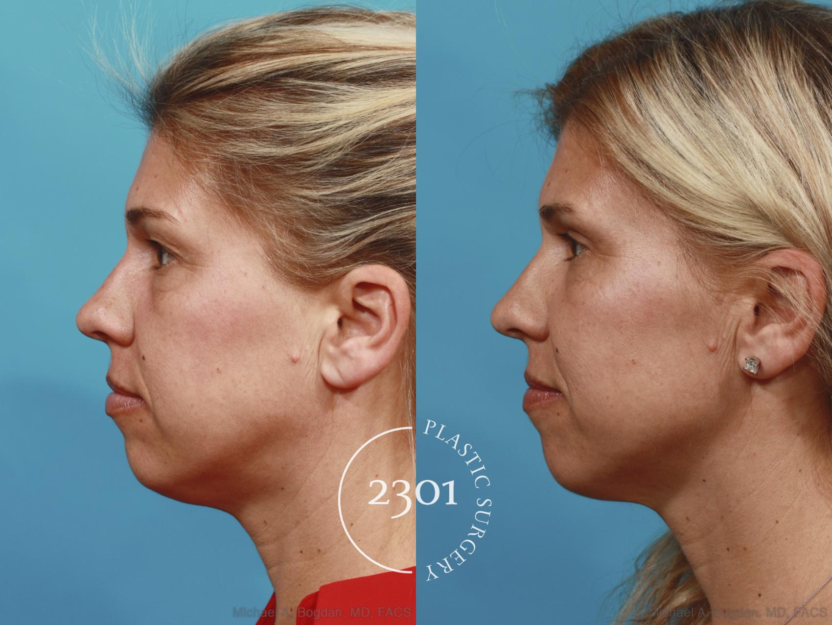Before & After Blepharoplasty Case 589 View #3 View in Fort Worth, Plano, & Frisco, Texas