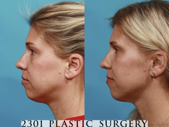 Before & After Blepharoplasty Case 589 View #3 View in Fort Worth, Plano, & Frisco, Texas