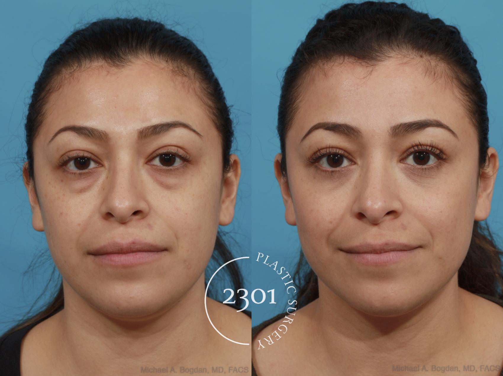 Before & After Blepharoplasty Case 590 View #1 View in Fort Worth, Plano, & Frisco, Texas