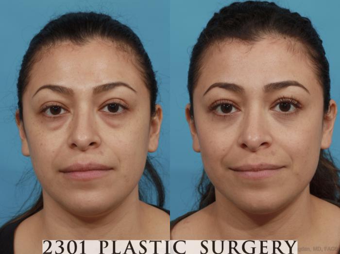 Before & After Blepharoplasty Case 590 View #1 View in Fort Worth, Plano, & Frisco, Texas