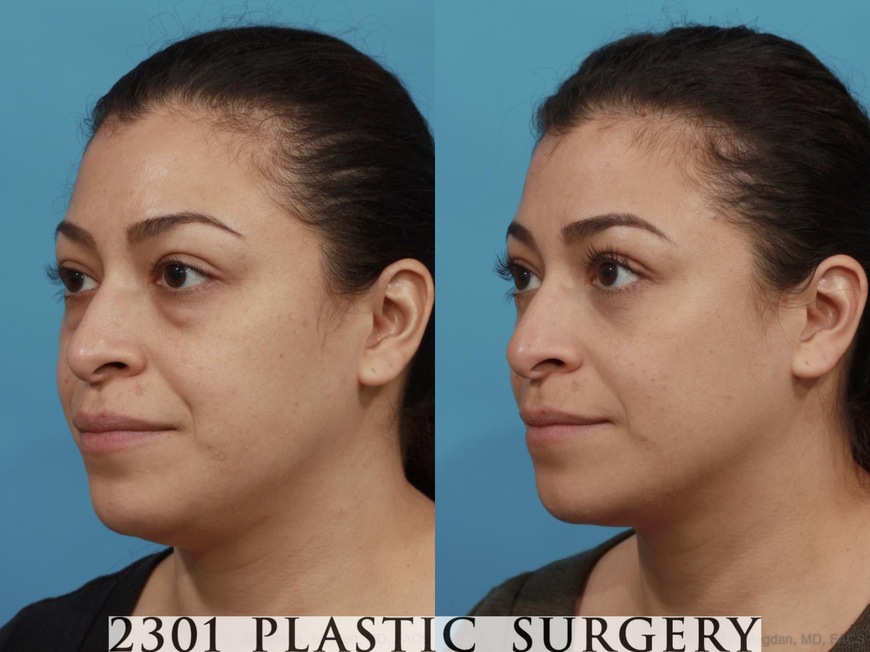 Before & After Blepharoplasty Case 590 View #2 View in Fort Worth & Frisco, Texas