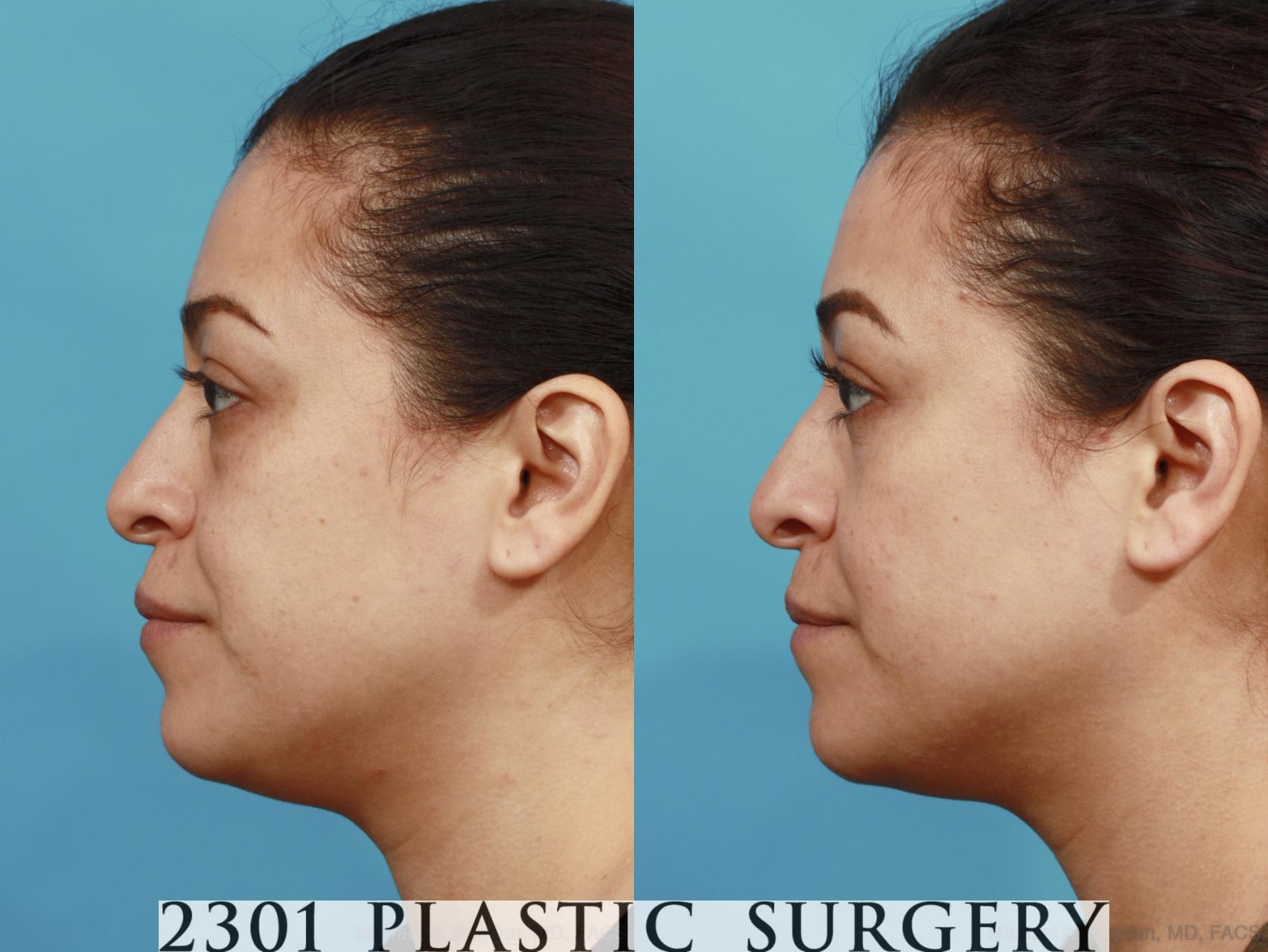 Before & After Blepharoplasty Case 590 View #3 View in Fort Worth & Frisco, Texas