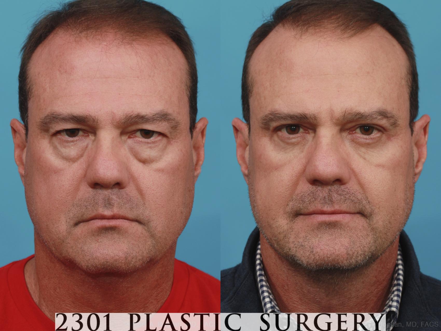 Before & After Male Eyelid Surgery Case 596 View #1 View in Fort Worth, Plano, & Frisco, Texas