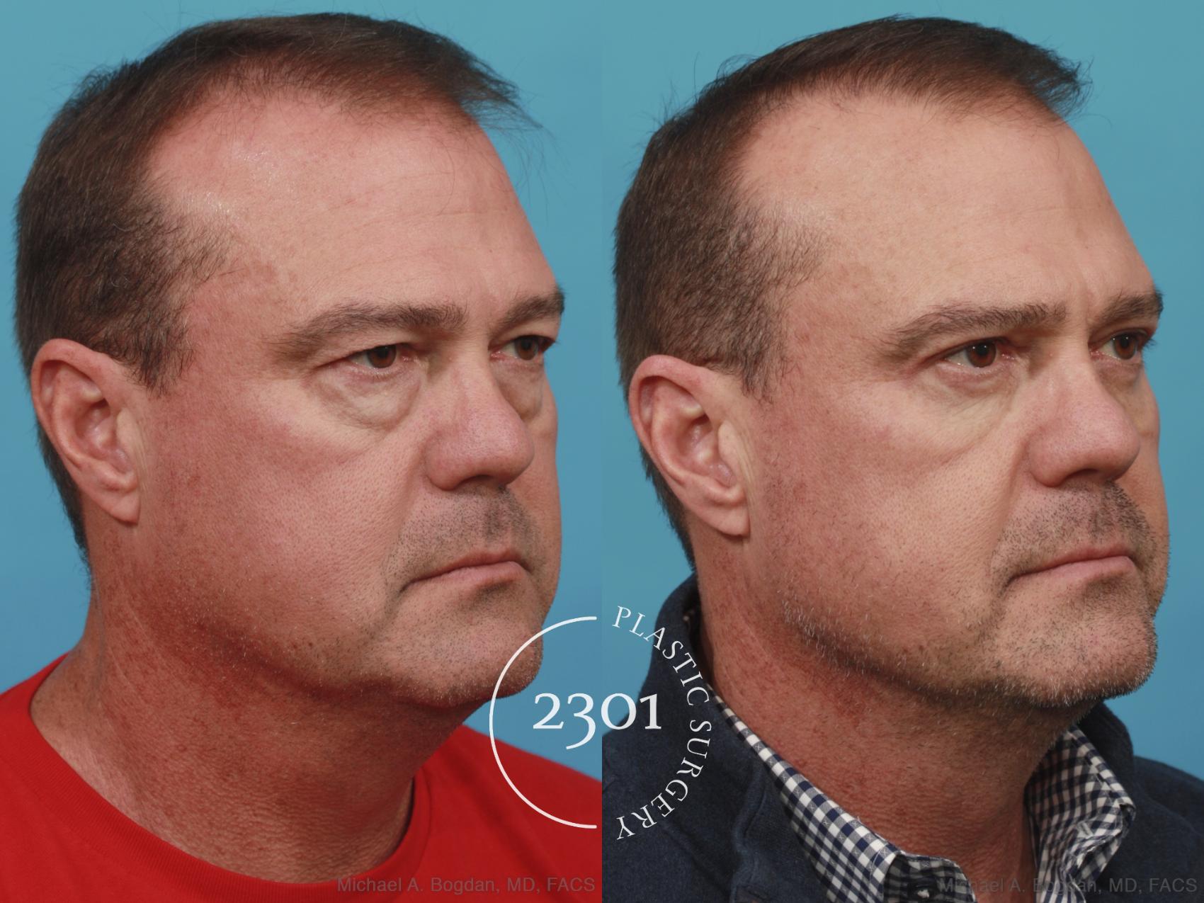 Before & After Blepharoplasty Case 596 View #2 View in Fort Worth, Plano, & Frisco, Texas