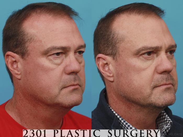 Before & After Blepharoplasty Case 596 View #2 View in Fort Worth, Plano, & Frisco, Texas