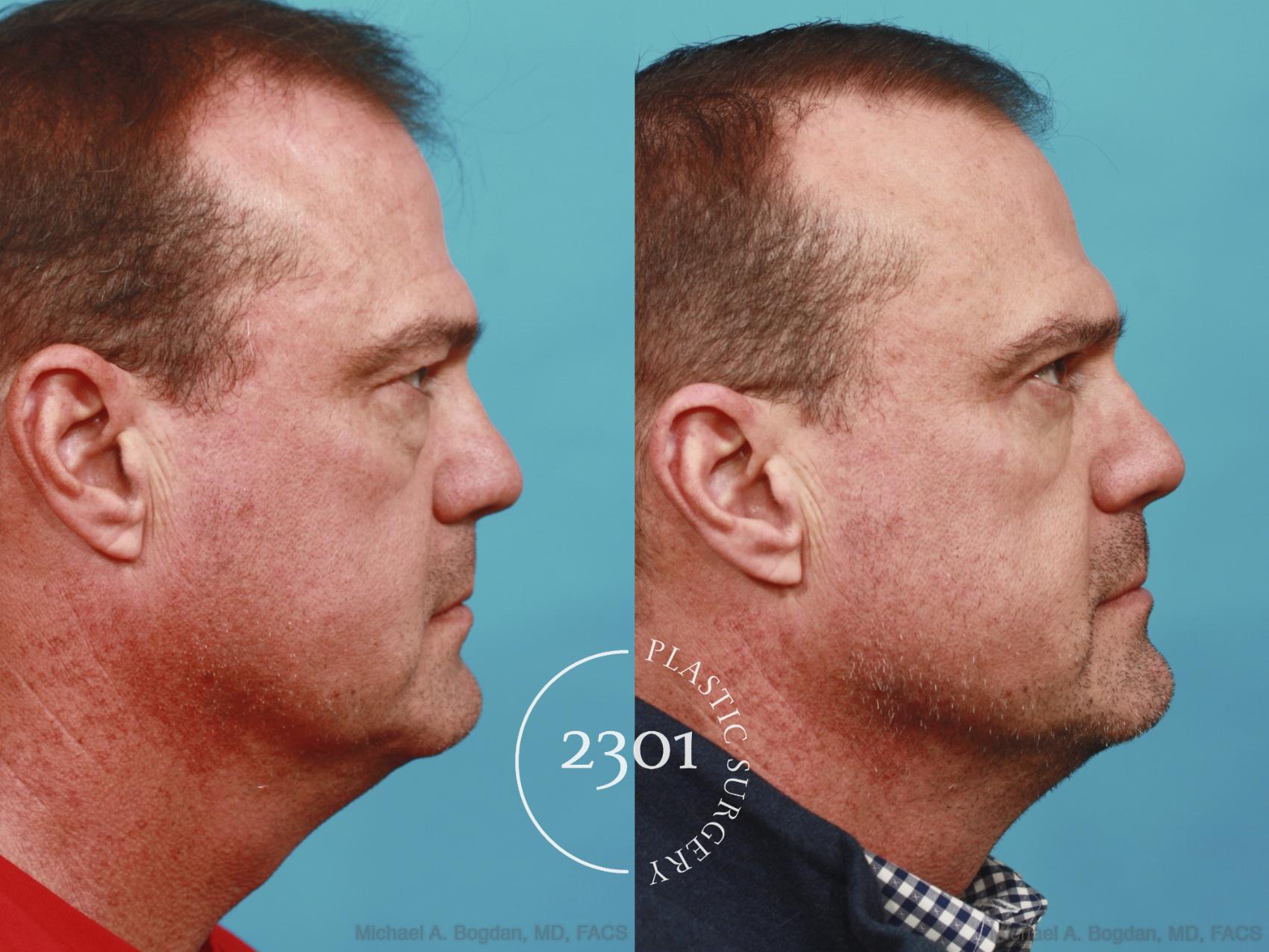 Before & After Blepharoplasty Case 596 View #3 View in Fort Worth, Plano, & Frisco, Texas