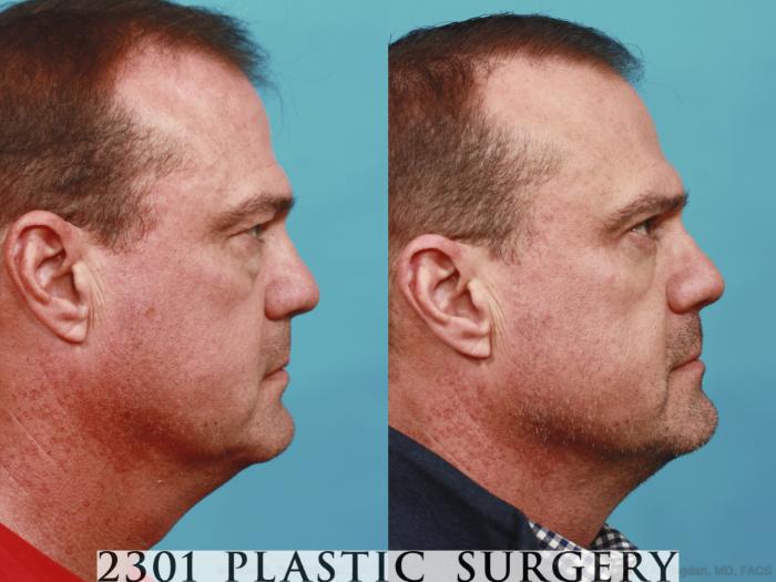 Before & After Male Eyelid Surgery Case 596 View #3 View in Fort Worth, Plano, & Frisco, Texas