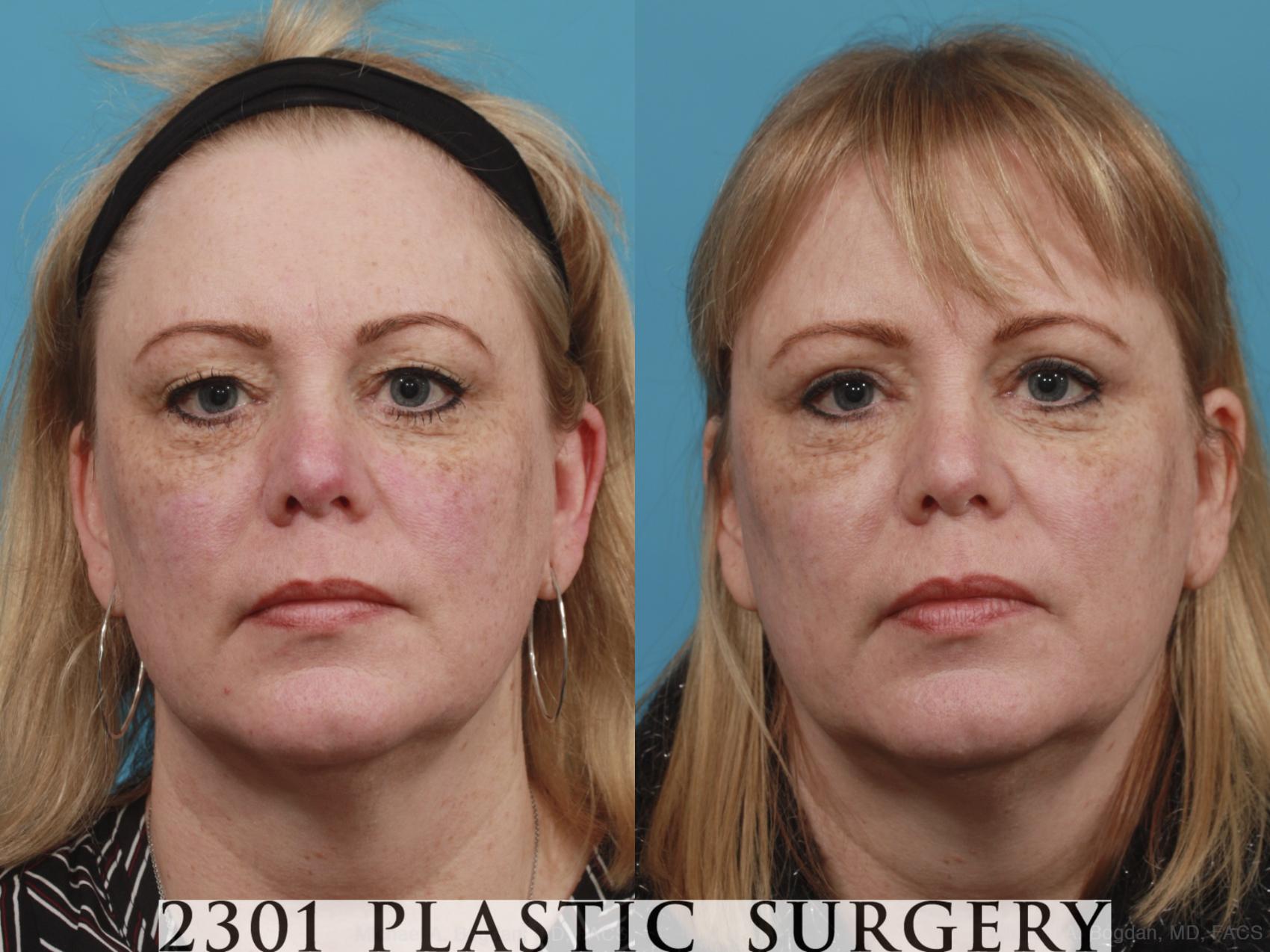 Before & After Blepharoplasty Case 605 View #1 View in Fort Worth, Plano, & Frisco, Texas