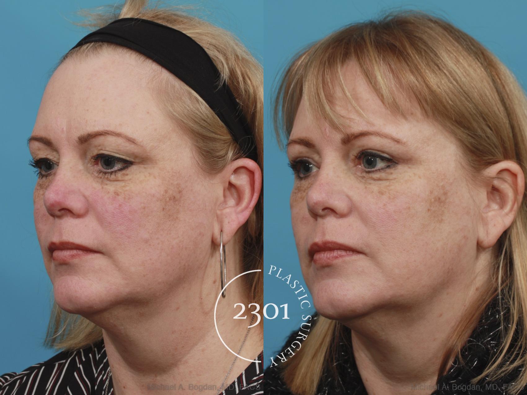 Before & After Blepharoplasty Case 605 View #2 View in Fort Worth, Plano, & Frisco, Texas