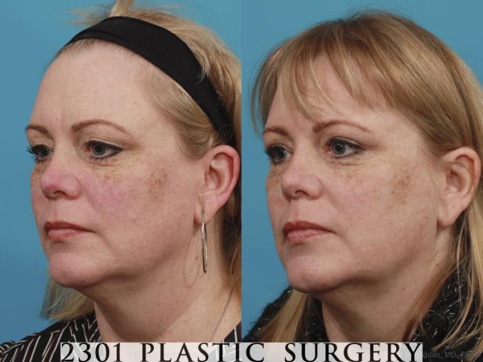 Before & After Blepharoplasty Case 605 View #2 View in Fort Worth, Plano, & Frisco, Texas