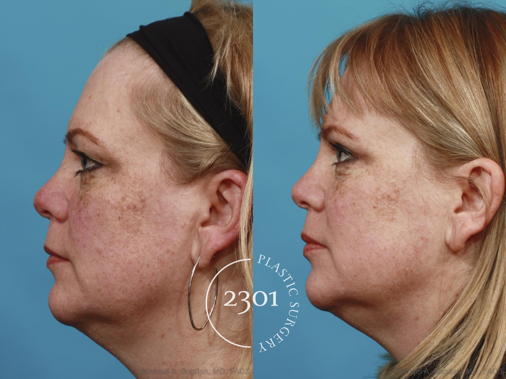 Before & After Blepharoplasty Case 605 View #3 View in Fort Worth, Plano, & Frisco, Texas