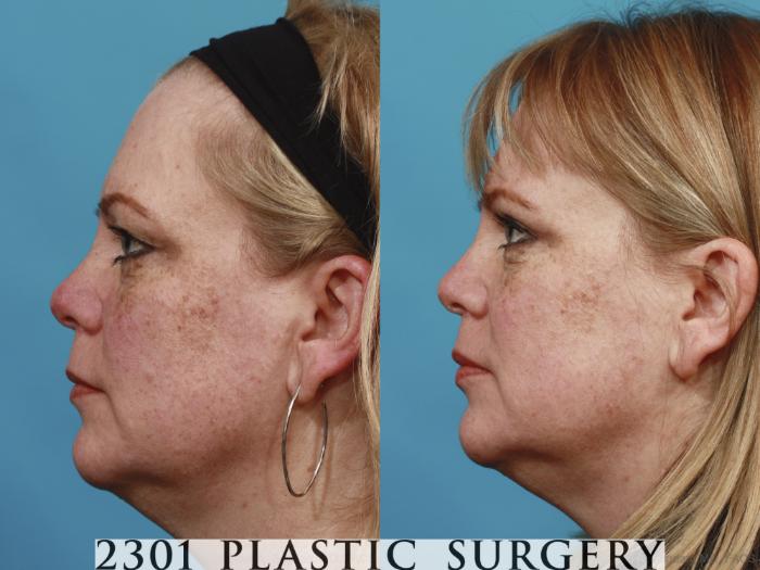 Before & After Blepharoplasty Case 605 View #3 View in Fort Worth, Plano, & Frisco, Texas
