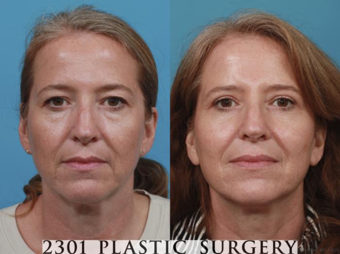 Before & After Blepharoplasty Case 618 Front View in Fort Worth, Plano, & Frisco, Texas