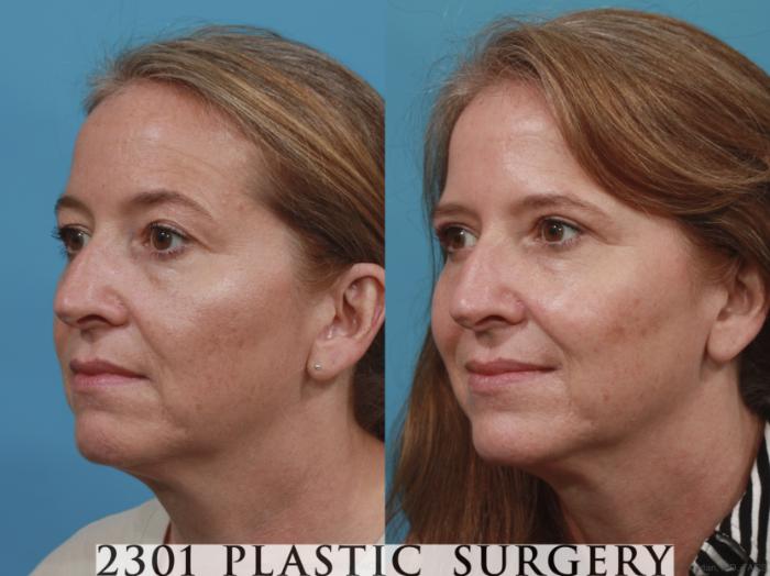Before & After Blepharoplasty Case 618 Left Oblique View in Fort Worth, Plano, & Frisco, Texas