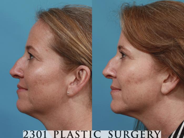 Before & After Blepharoplasty Case 618 Left Side View in Fort Worth, Plano, & Frisco, Texas