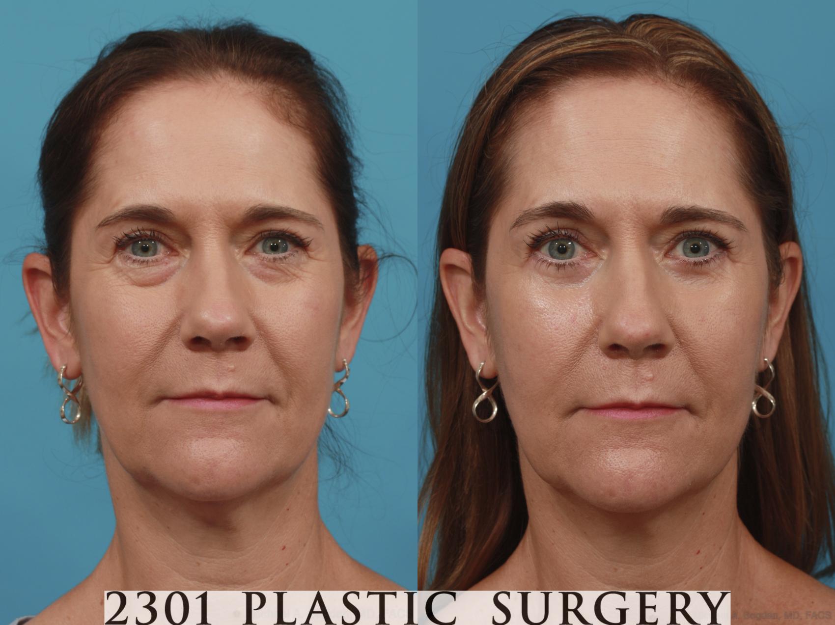 Before & After Blepharoplasty Case 619 Front View in Fort Worth & Frisco, Texas