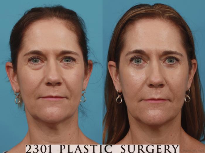 Before & After Blepharoplasty Case 619 Front View in Fort Worth, Plano, & Frisco, Texas