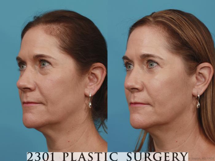 Before & After Blepharoplasty Case 619 Left Oblique View in Fort Worth, Plano, & Frisco, Texas