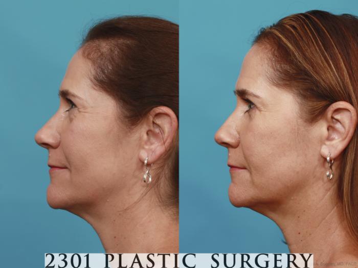 Before & After Blepharoplasty Case 619 Left Side View in Fort Worth, Plano, & Frisco, Texas