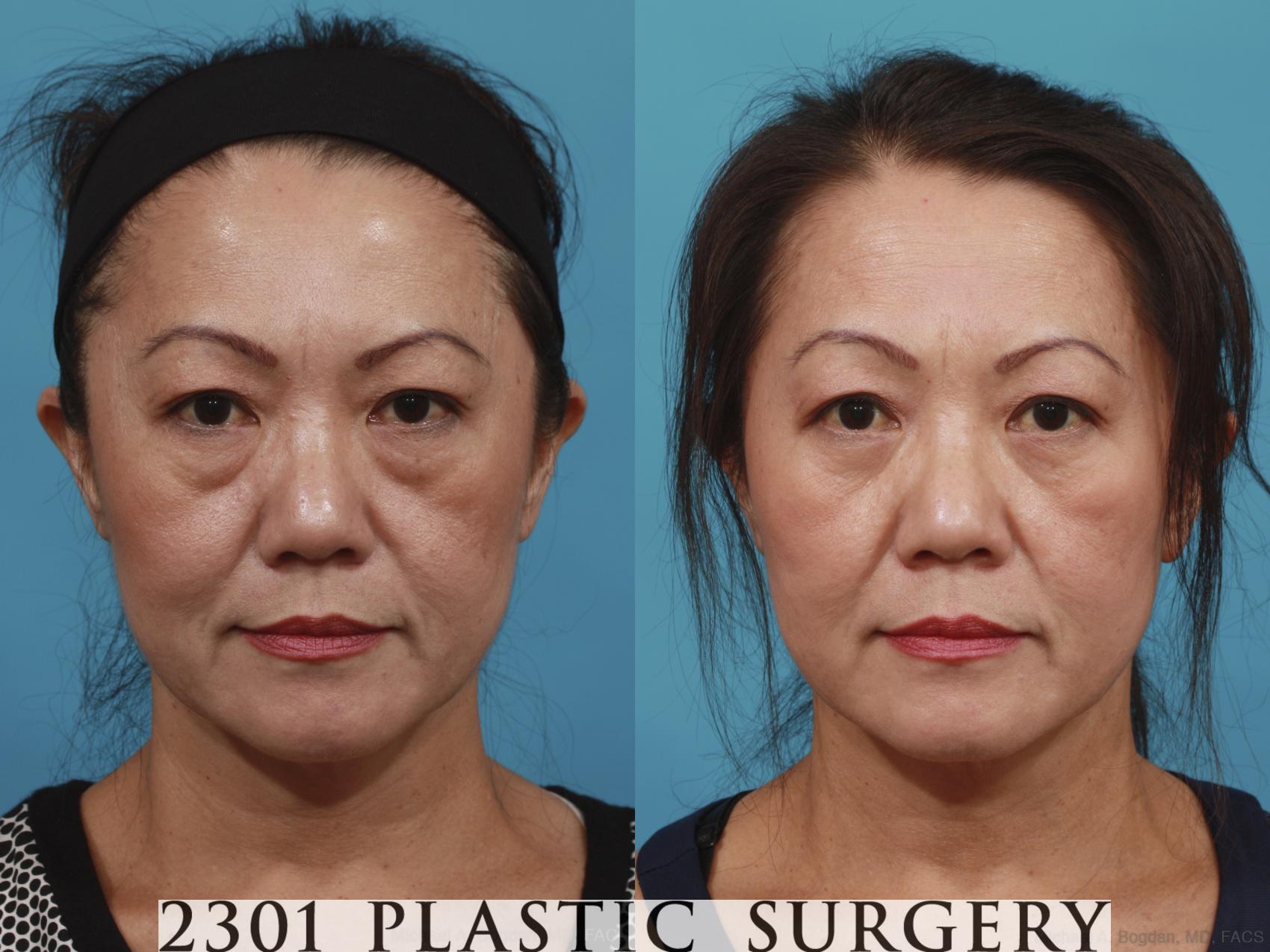 Before & After Blepharoplasty Case 620 Front View in Fort Worth, Plano, & Frisco, Texas