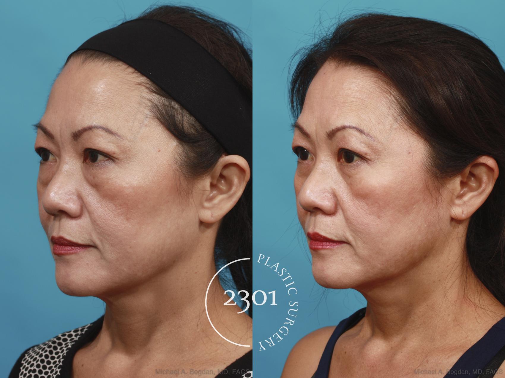 Before & After Blepharoplasty Case 620 Left Oblique View in Fort Worth, Plano, & Frisco, Texas
