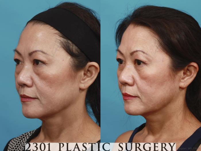 Before & After Blepharoplasty Case 620 Left Oblique View in Fort Worth, Plano, & Frisco, Texas
