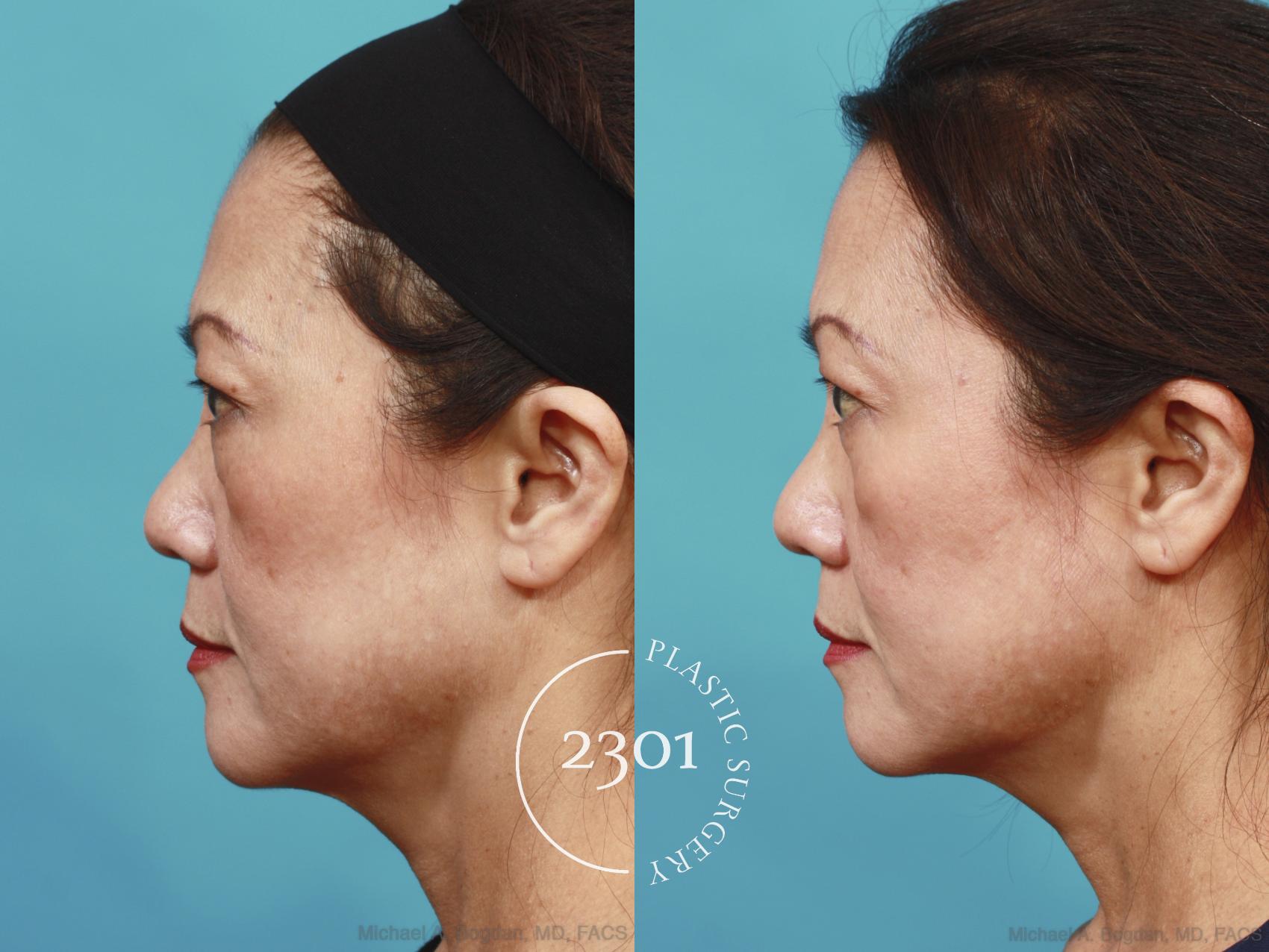Before & After Blepharoplasty Case 620 Left Side View in Fort Worth, Plano, & Frisco, Texas