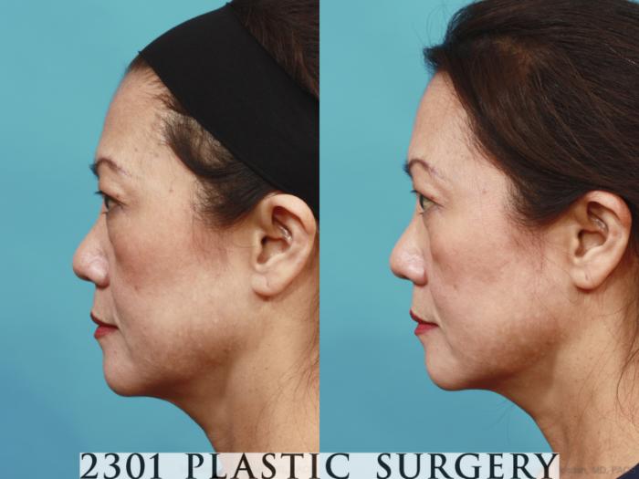 Before & After Blepharoplasty Case 620 Left Side View in Fort Worth, Plano, & Frisco, Texas