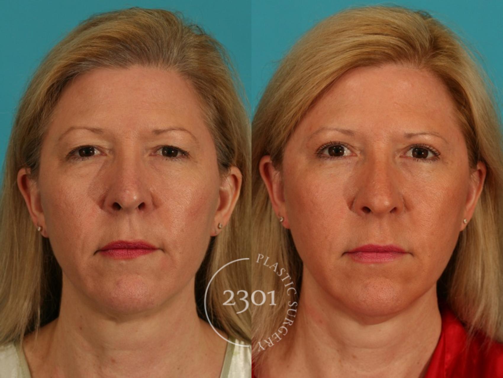 Before & After Blepharoplasty Case 67 View #1 View in Fort Worth, Plano, & Frisco, Texas