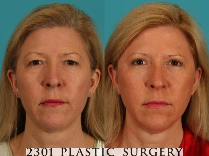 Before & After Skin Resurfacing Case 67 View #1 View in Fort Worth & Frisco, Texas
